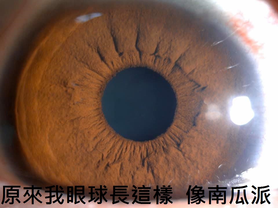 SMILE全飛秒近視雷射術後分享、SMILE pro全飛秒近視雷射術後分享、SMILE pro、visumax 800