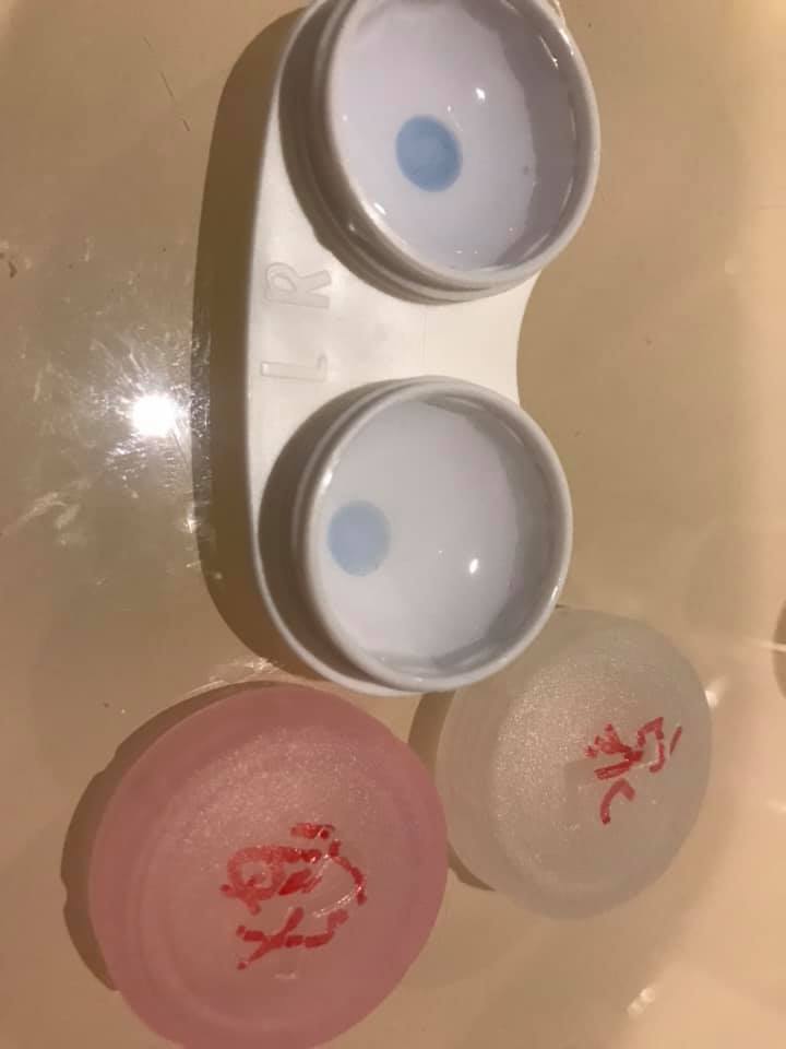 近視雷射取出的角膜透鏡,手術會點麻藥,所以不會有什麼感覺。SMILE全飛秒近視雷射術後分享、SMILE pro全飛秒近視雷射術後分享、SMILE pro、visumax 800