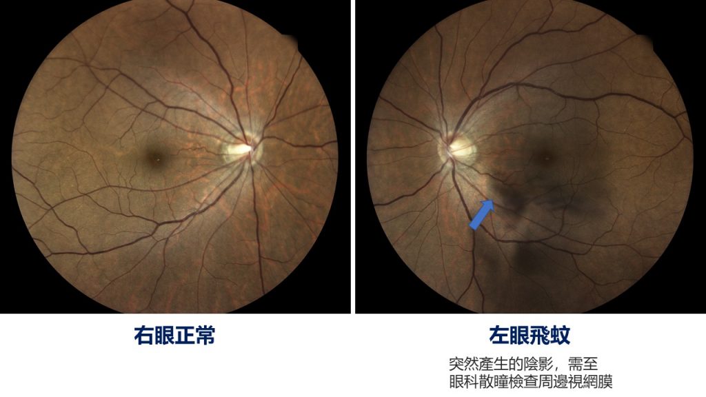 左眼飛蚊症，突然產生陰影，需至眼科散瞳檢查周邊視網膜