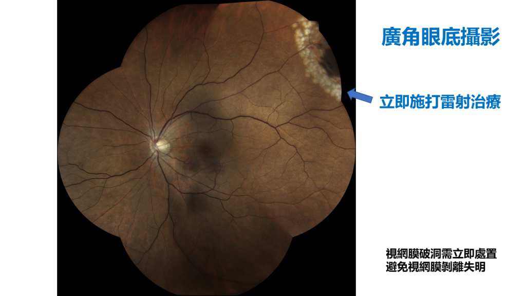 視網膜破洞需立即處置，避免視網膜剝離失明