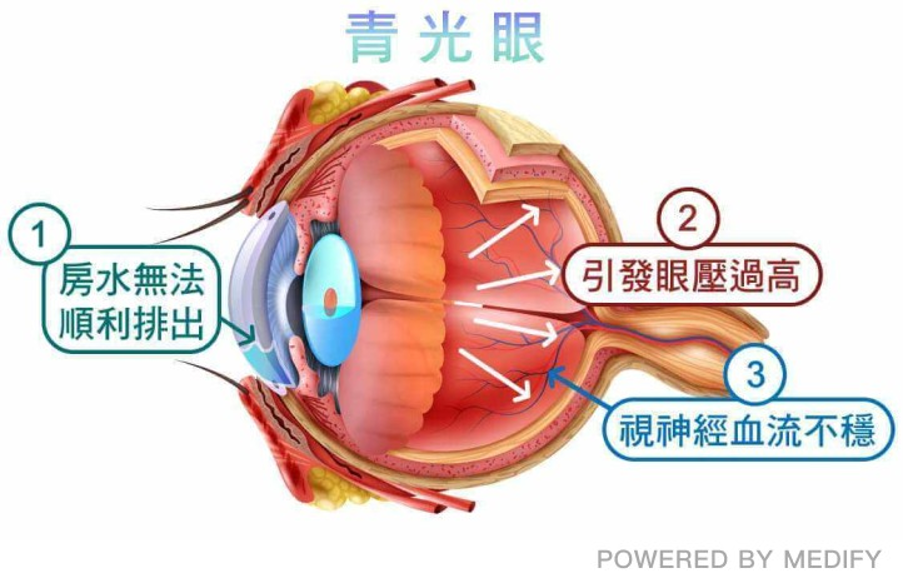 眼球房水與青光眼的關係