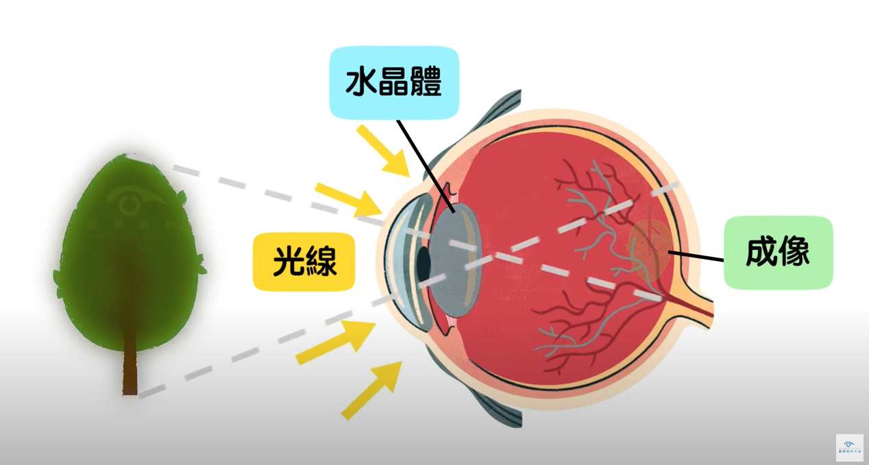 白內障成因
