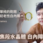 飛秒白內障手術