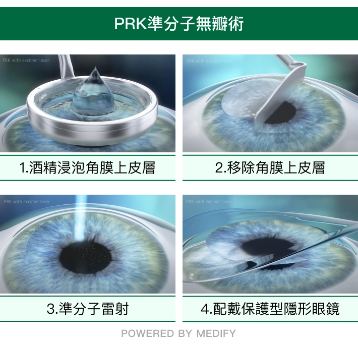 PRK手術步驟