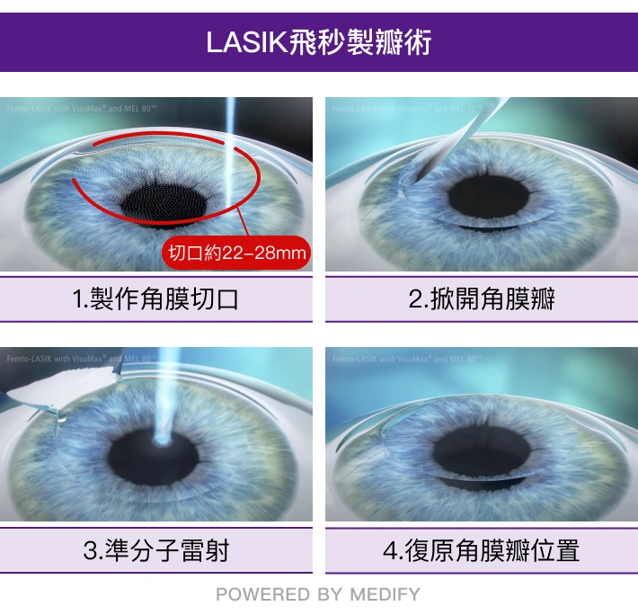 lasik手術步驟