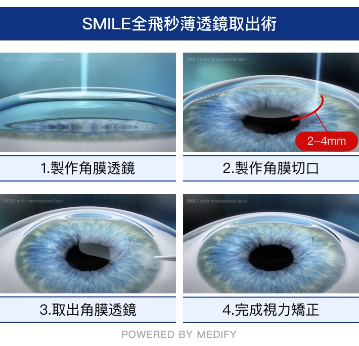 smile pro 手術步驟
