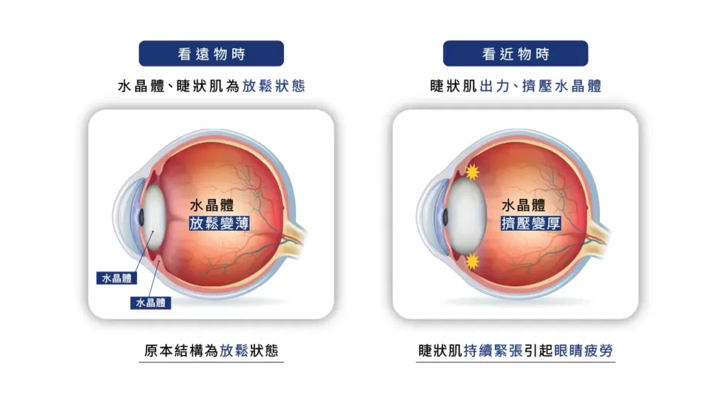 老花眼看近物睫狀肌出力方式
