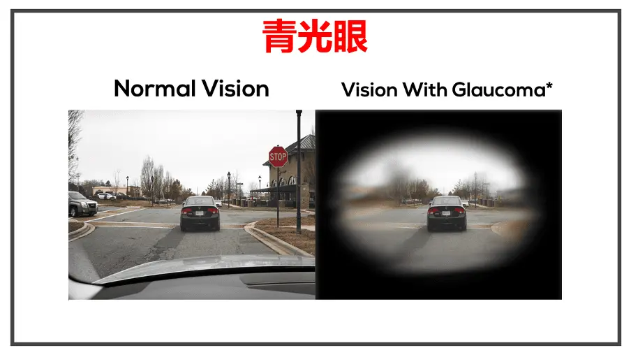 青光眼與正常眼視野對比