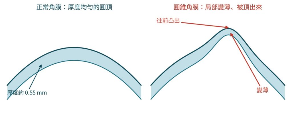左：正常角膜是厚度均勻的圓頂。右：圓錐角膜局部變薄、變弱，被眼內壓力慢慢往前頂出來。（模擬示意圖）