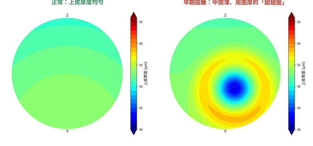 左：正常，上皮厚度均勻。右：早期圓錐角膜典型的「甜甜圈」——中間薄（藍）、周圍厚（黃橘）。（模擬示意圖）