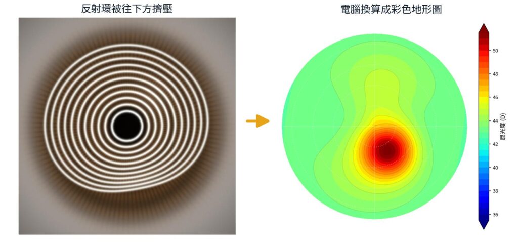 左：這顆角膜的反射環被往下方擠壓。右：同一顆角膜的彩色地形圖，下方出現一團紅色。（模擬示意圖）