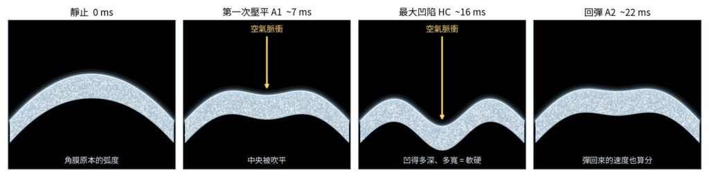 超高速相機拍下的三十毫秒：靜止、第一次壓平、最大凹陷、回彈。凹得多深、彈得多快，就是角膜軟硬的指標。（模擬示意圖）