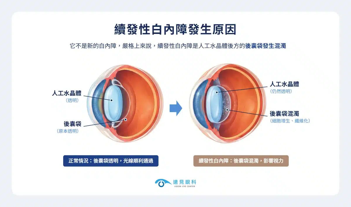 破除迷思：續發性白內障是白內障復發嗎？示意圖